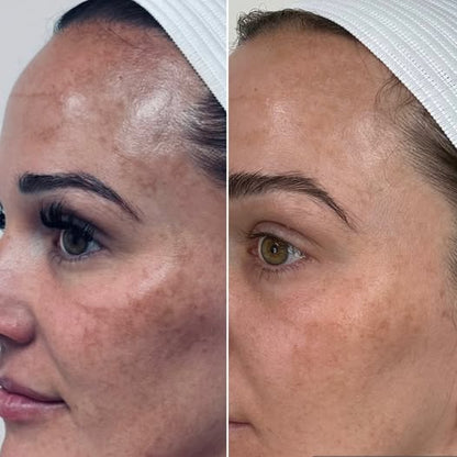 LumiDerm™ Korean Dark Spot Renewal Cream
