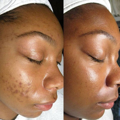 LumiDerm™ Korean Dark Spot Renewal Cream